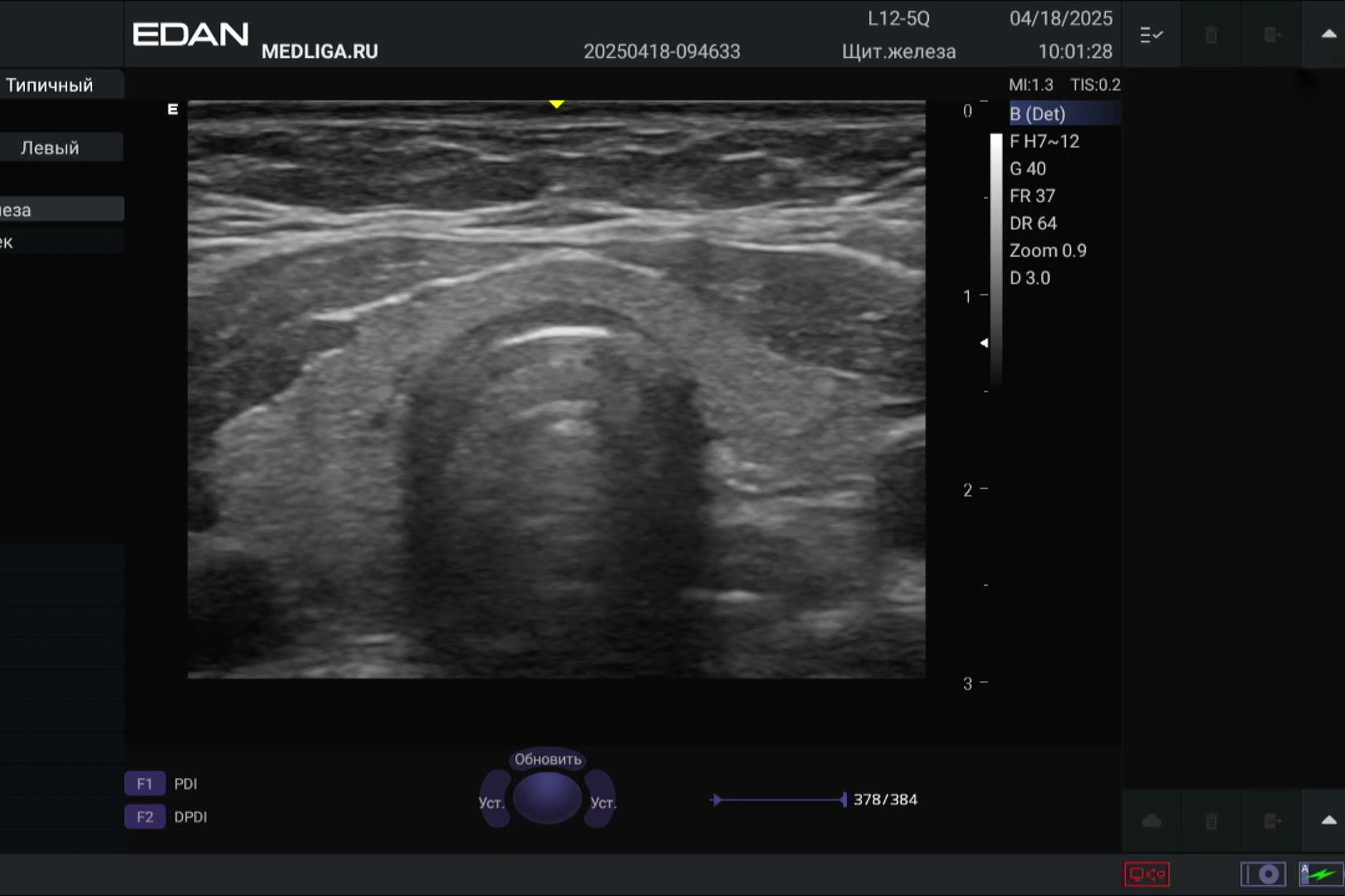 УЗИ щитовидной железы: тест сканера EDAN Acclarix AX3