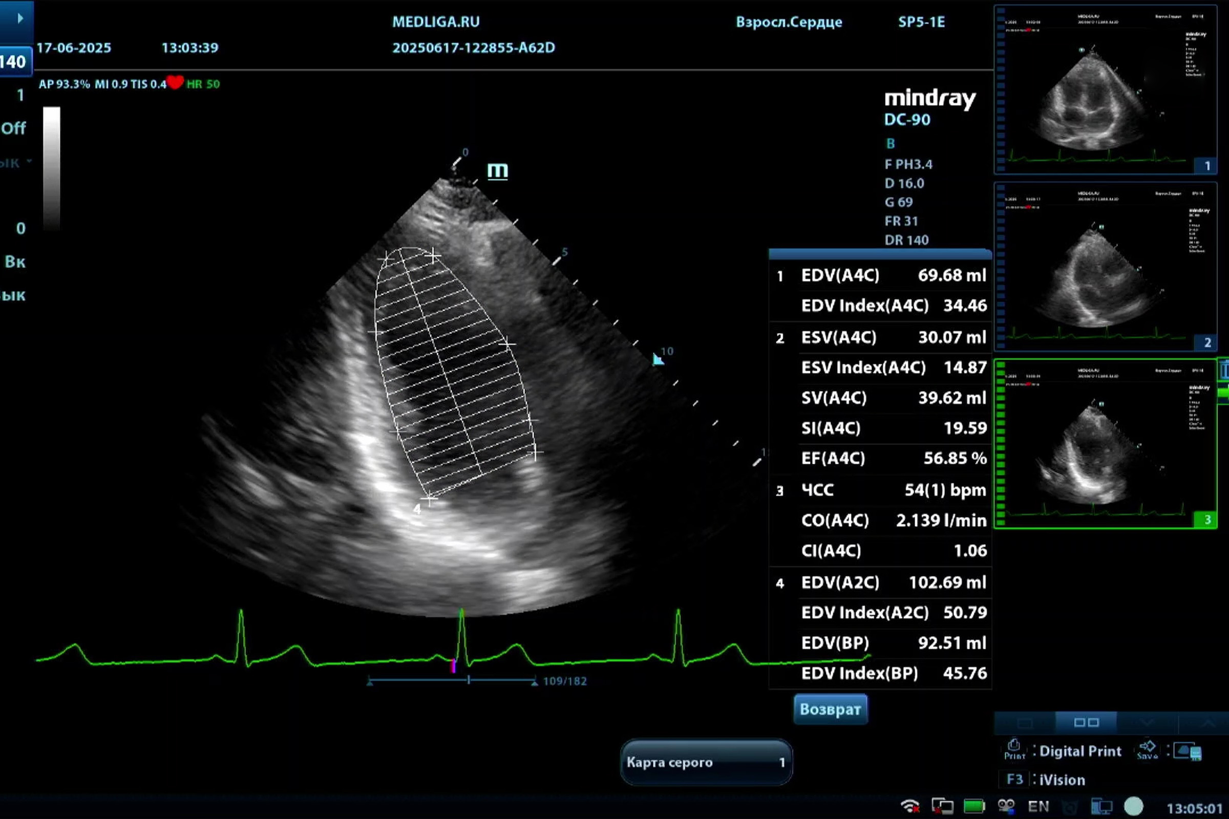Практика на Mindray DC-90: как посчитать EROA, лонгитудинальный Strain и фракцию выброса по Симпсону?