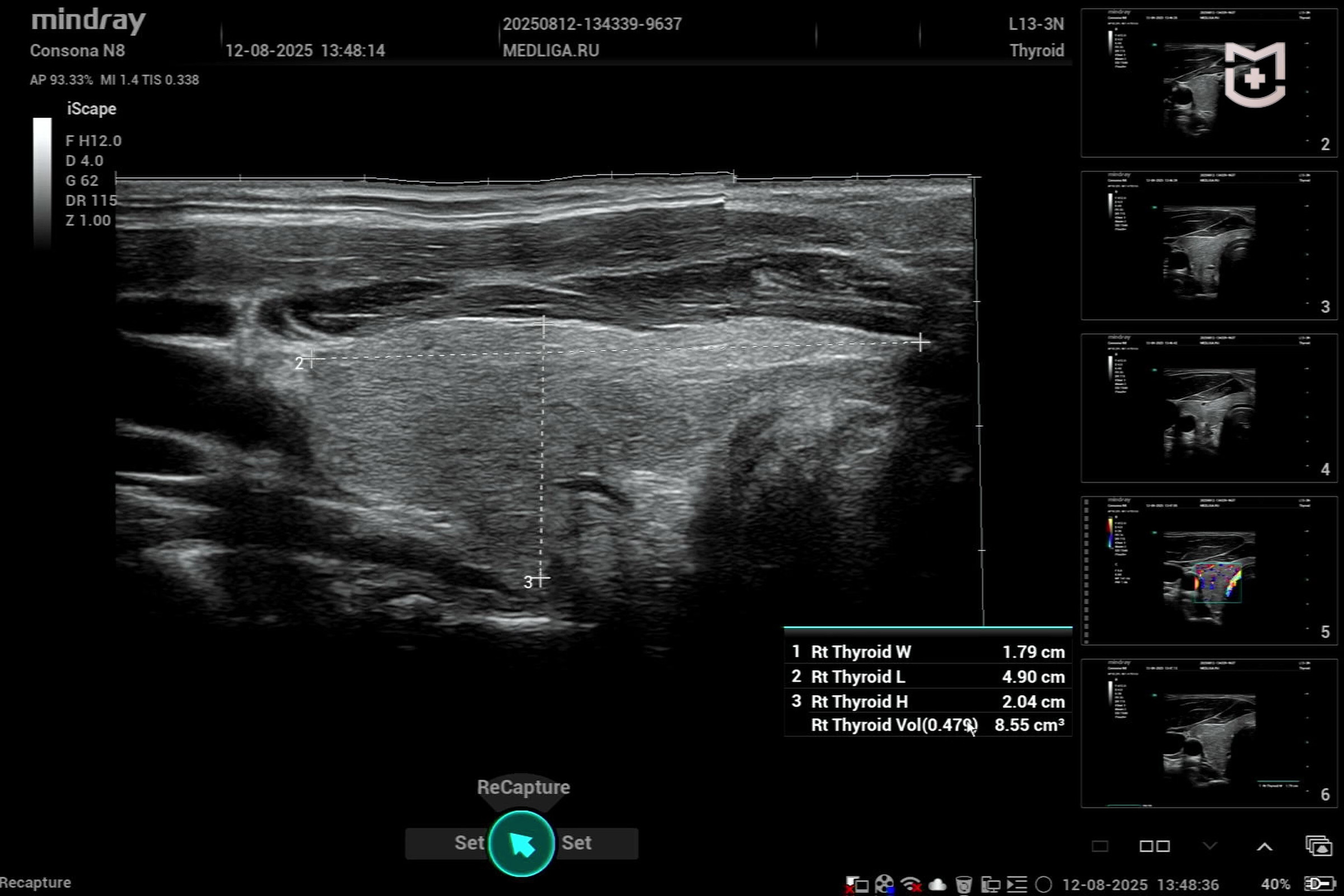 Разбор возможностей Mindray Consona N8: УЗИ щитовидной железы